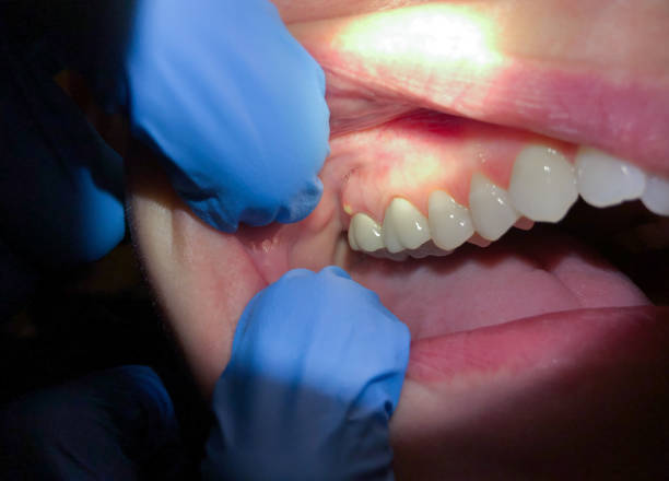 Best Emergency Treatment for Dental Infections or Abscesses in Melody Hill, IN